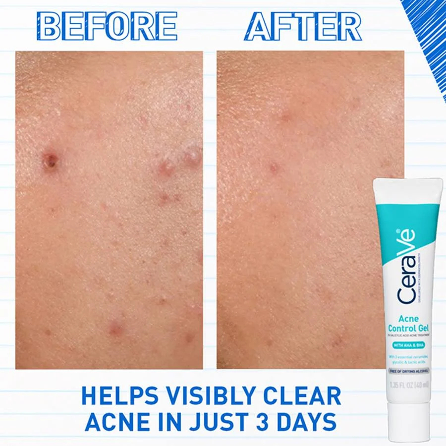 CERAVE Acne Blemish Control Gel 40ml for Ubat Jerawat, Acne Cream, Acne Spot Treatment
