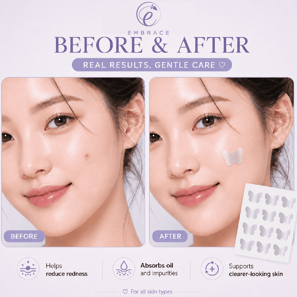 EMBRACE Beauty Acne Colour Patch (24's / 12's) - Cutesy Butterflies for Acne Patch, Patch Jerawat