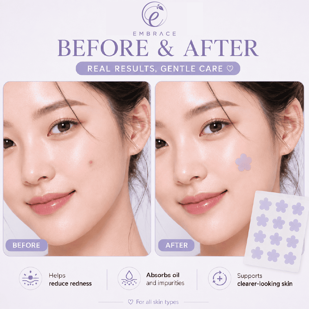 EMBRACE Beauty Acne Colour Patch (24's / 12's) - Flower Petals for Acne Patch, Patch Jerawat