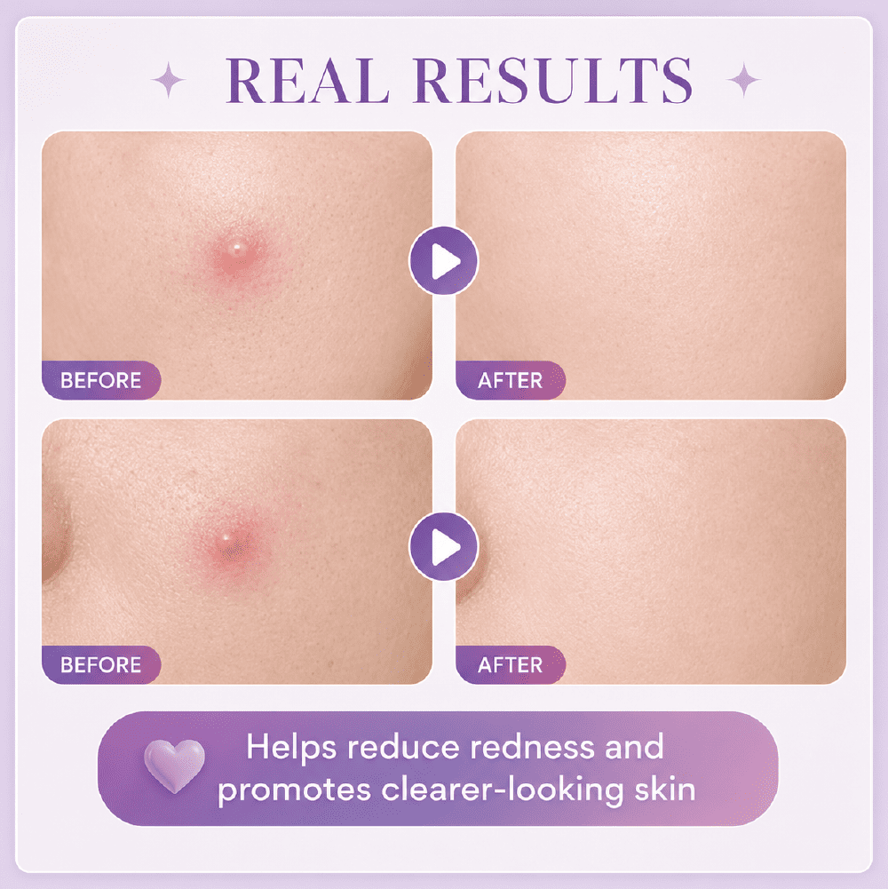 EMBRACE Beauty Acne Transparent Patch (24's / 12's) - Flower Petals for Acne Patch, Patch Jerawat